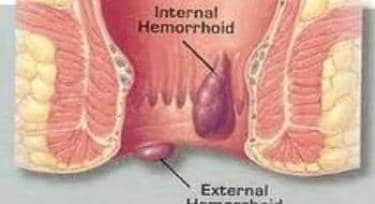 Hemorrhoids graphic